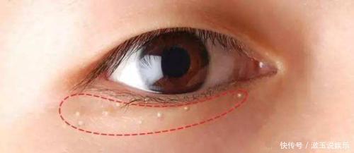 长了脂肪粒怎么办不能用手抠也不能抓挠,教你真正的去除办法