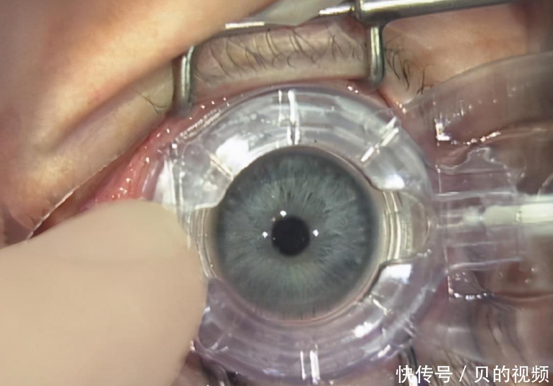 家长|孩子近视几岁才能做“激光手术”?早于这岁数,做了也是白做