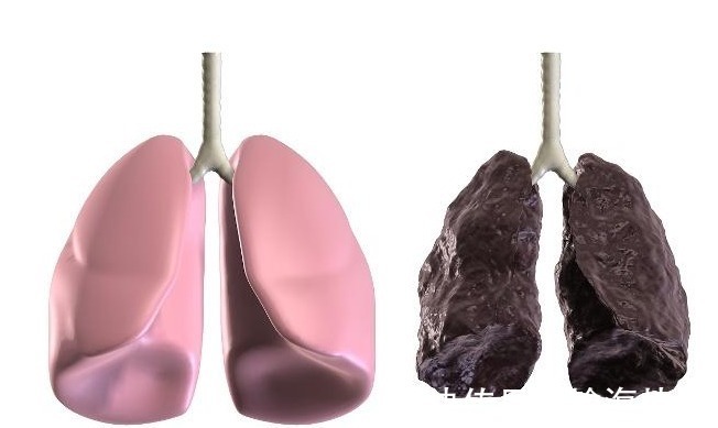 干咳|“肺癌”早期,不止是干咳,身体还可能发出4个“警报”别忽视!