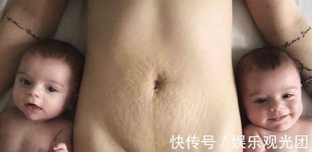 伤口|剖腹产,竖切口和横切口有什么区别?作为产妇,应该怎么选择