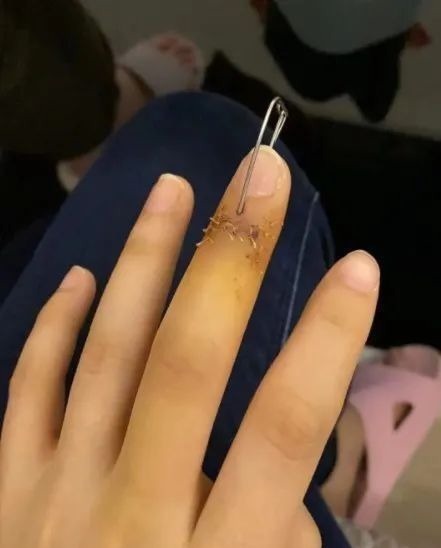 垃圾|女子扔个垃圾，手指断了要手术！这个习惯很多人也有