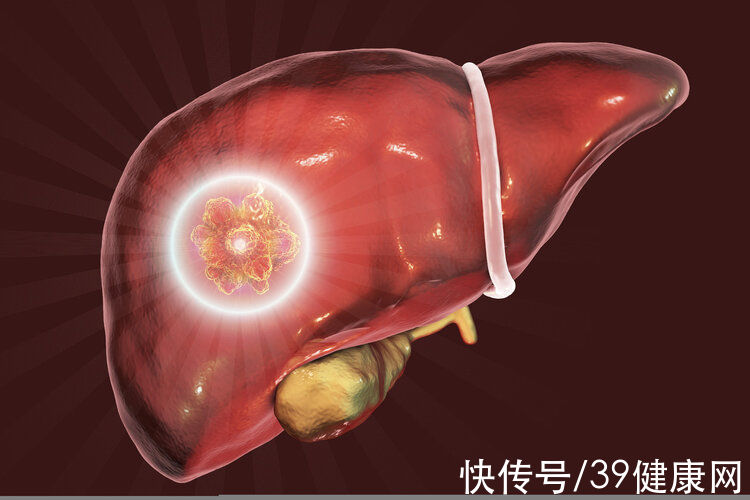 hbv|34岁男子确诊“肝癌晚期”，不抽烟喝酒：这2个饮食习惯害了他