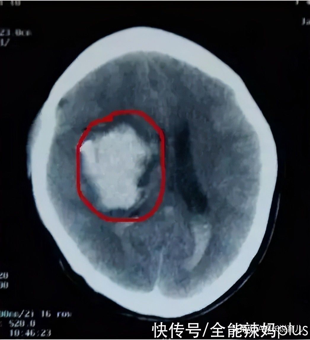 谨记|孙子翻身掉床，奶奶一个动作令娃永远离开：摔倒谨记“黄金3步”