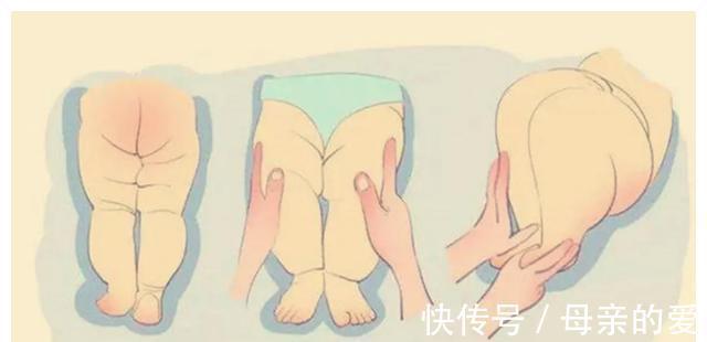发育性髋关节脱位|宝宝臀纹不对称,家长一定要注意