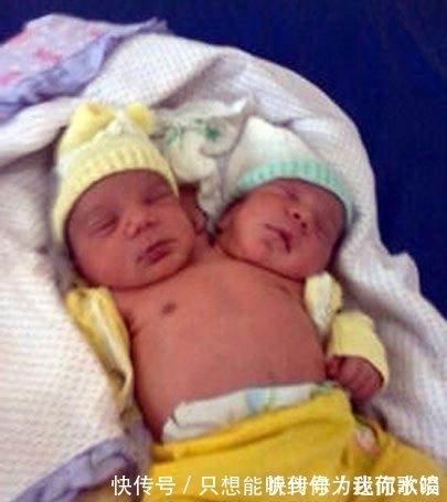 连体|若连体婴儿其中一个不幸离世,另一个会怎样呢?