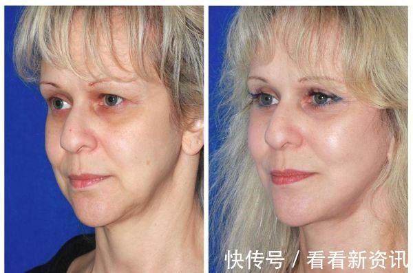 激光 几个不动刀就能变美的医美项目,你最种草哪一个!