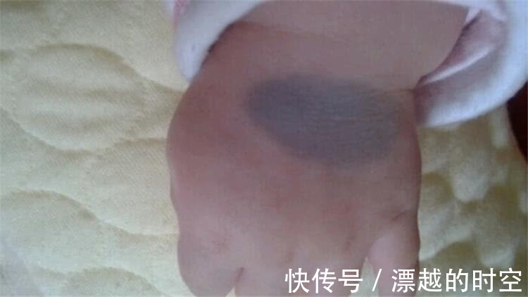 阎王爷|胎记是怎么来的,有人说是被阎王爷打答案可能不是你所想的