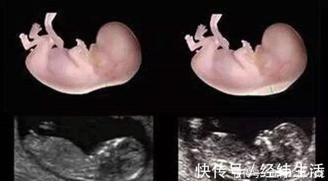 透明膜|孕期产检不想生个“傻孩子”,这三项产检必须按时做,不能忽视