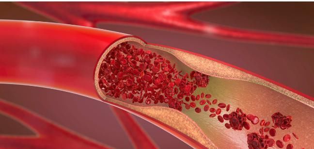 癌症|癌症为什么会导致血栓?多与2个原因有关,做好3点可预防