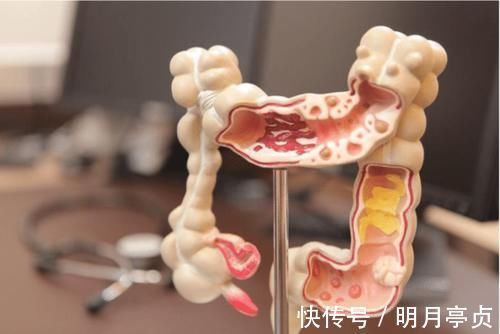 泻药|55岁男子长期便秘,查出肠癌,医生:长期便秘不是小事,别拖