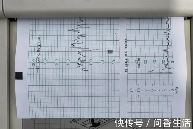 胎动|进行胎心监护,一会儿合格,一会儿不合格,是胎儿“缺氧”吗?