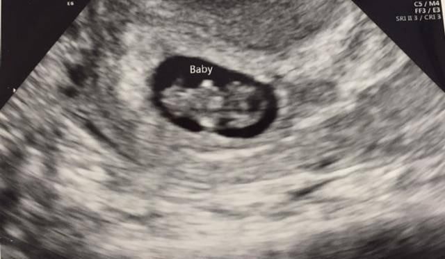 孕囊|孕早期，孕妈第一次产检，如果三个指标合格，恭喜你，胎儿很健康