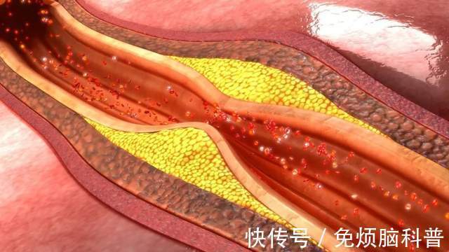 血管垃圾|高血压患者，增强血管弹性，排出血管垃圾，这三种菜肴有益降血压