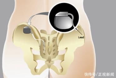 新闻记者|女子不惑之年患上尿失禁 膀胱起搏器助力重获“自由”人生