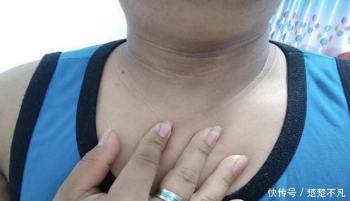 检查|6岁女儿脖颈发黑洗不掉，送医院检查，医生的解释令宝妈哭笑不得