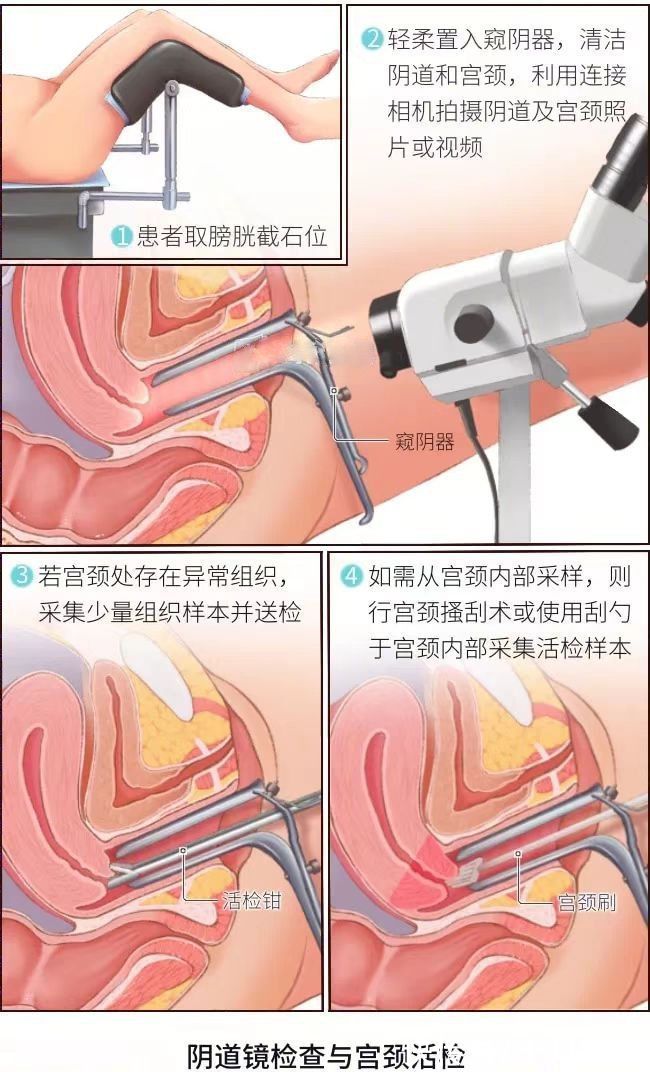 瑟瑟发抖|揭秘最可怕的妇科检查：从阴道里割肉，到底有多疼？