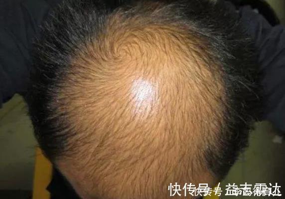 刘医师|中医坦露:脾虚身体有4个毛病!牢记3个妙方,让脾胃强健起来!