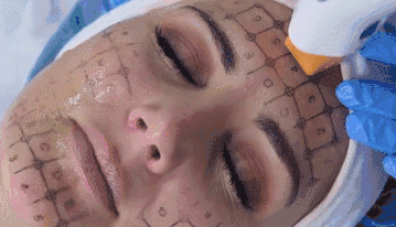 真皮层 热玛吉做完之后皮肤会不会加速衰老?不同年龄段做了热玛吉都会有什么改变?