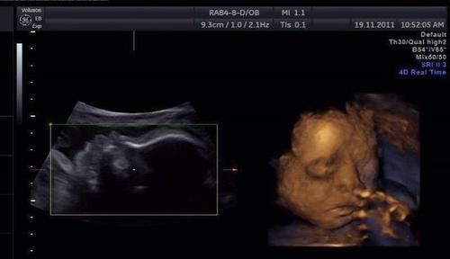 畸形|孕检结果正常,却生出畸形宝宝,怀孕多少周做排畸检查准确率最高