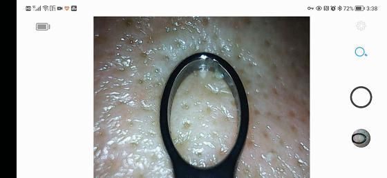 青春|洁净看得见,让青春轻松战“痘”: 媄拾智能可视毛孔清洁仪