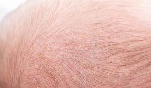 宝妈|你家宝宝头上有舅舅屎吗?这样处理不伤头皮,赶紧get起来