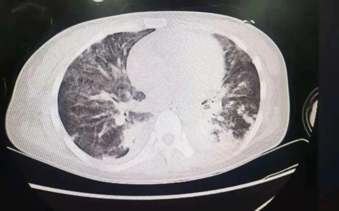 女子|30岁女子两肺“发白”被疑严重肺炎?没想到竟是肺里堆满了它