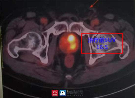 病区|万杰医院：贴心服务暖人心32次前列腺癌精准质子治疗获好评