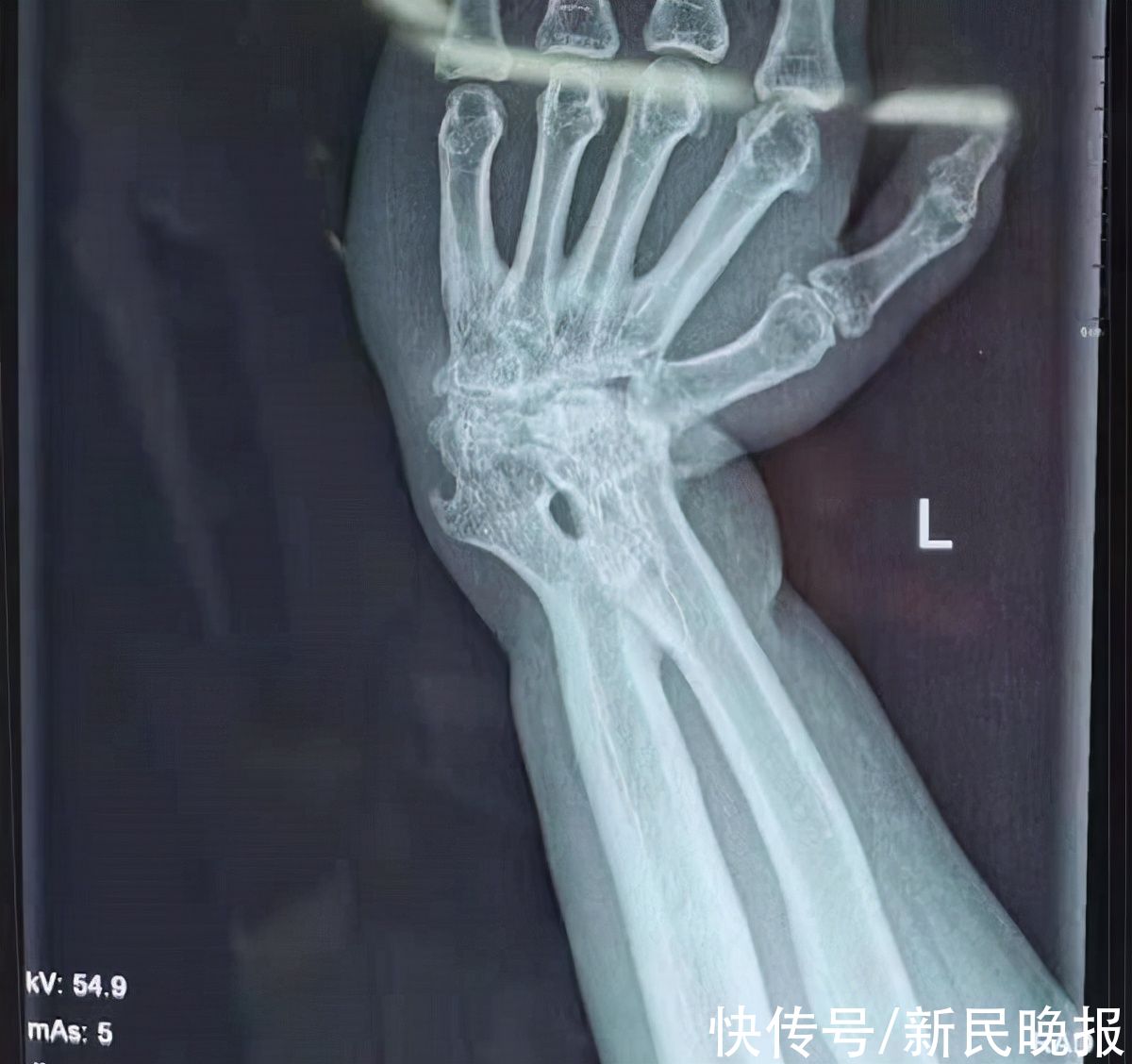 手腕|严重畸形18年手腕重获新生 假体系上海微创自主研发
