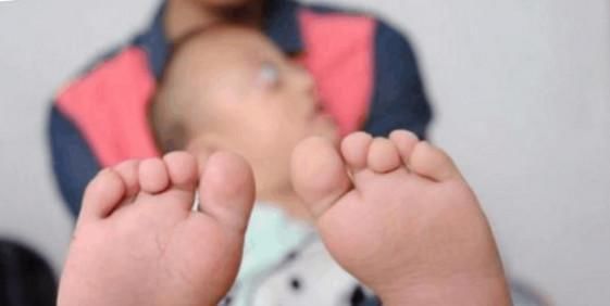 先天|夫妻先天缺陷坚持生孩子, 生下的孩子遗传了家族所有缺陷