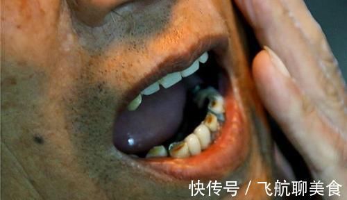 白细胞|癌症患者在化疗期间,需要注意什么医生牢记3要点,对身体好