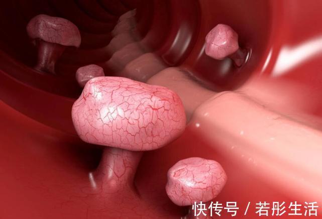 癌前病变|癌症都是拖出来的，再次提醒有4种病，和癌症走得“有点近”