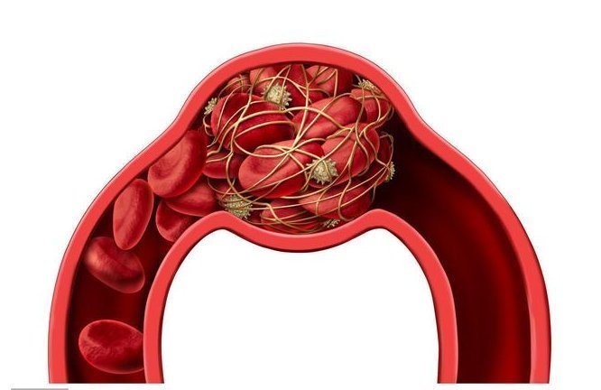 他汀药|脑梗不到1年就复发，如何预防？坚持做好3件事，养血管保健康