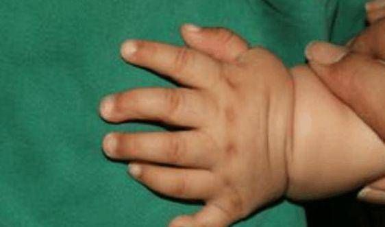 宝妈|婴儿出生时有30多个手指医生看到了宝妈的手,明白了原因