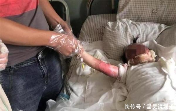 宠物|男孩掉进180度油锅,奶奶神反应救孩子一命,医生都夸她高明!