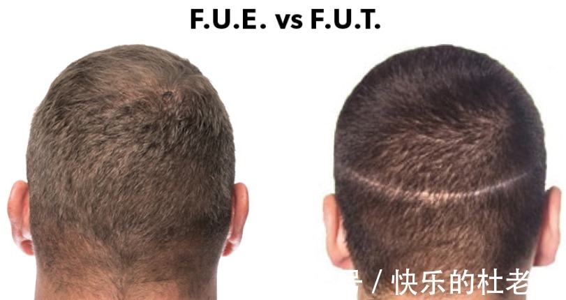 移植 植发后会掉发吗?谁要说百分百不掉发,不是心黑就是无知!