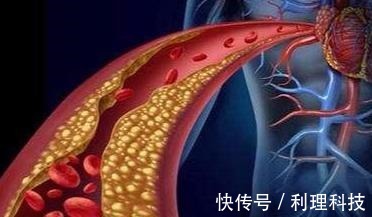 原发性|有7种表现可能血脂高了,医生提醒7项措施做好,保证血管顺畅