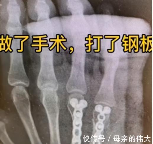 辅导|又一宗:辅导作业“气掉下巴”,面对“恐辅症”,家长需做好预防