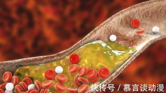 饮食习惯|茄子属于高血脂的“发物”吗?医生:预防高血脂,这3物尽量少吃