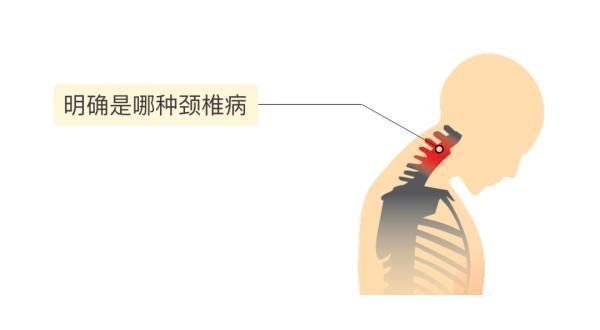 缺血性脑卒中|世纪坛专家：头晕、走路像踩棉花是怎么回事？