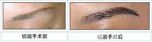 王小民教授 王小民教授:眼周衰老,提眉与切眉哪个更适合你呢?