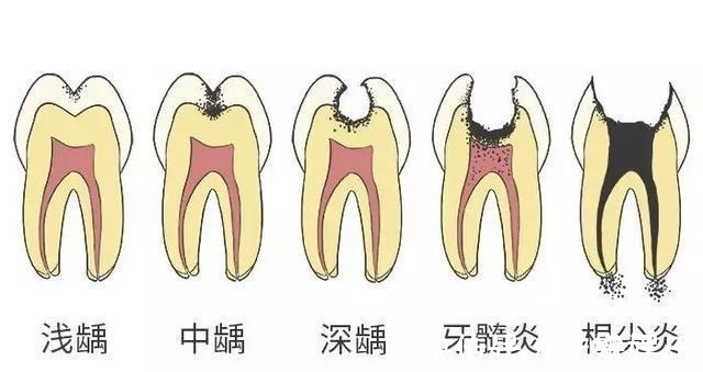 龋齿|4岁男孩牙齿几乎全黑6岁前,不要让孩子自己刷牙!