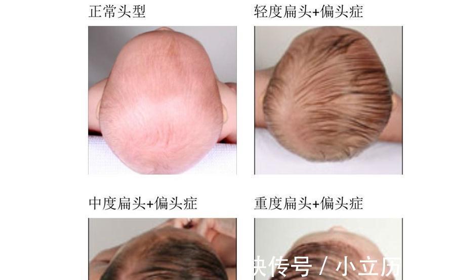 发育|宝宝睡觉时头总是偏向一边,要不要给他摆正?不懂的赶紧来看看!