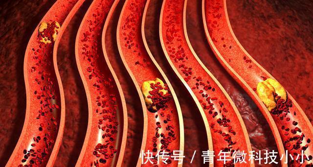 脂类|血脂高的人请注意：除了油和盐，还有1种食物要少吃，血脂不高