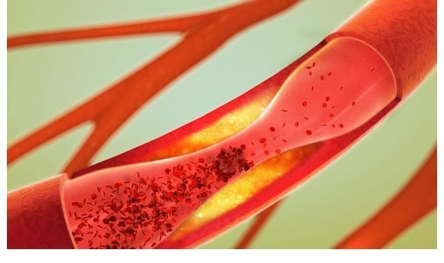 血脂|多走路就可以降血脂?心血管专家:过了50岁,1件事比运动更重要