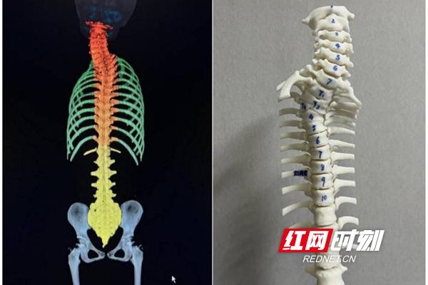 t3|湘雅三医院完成湖南首例“天玑”机器人辅助下的先天性脊柱侧弯矫形手术