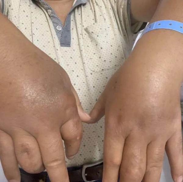 警惕!就吹了半小时空调,爷叔双手变形成了“馒头”…