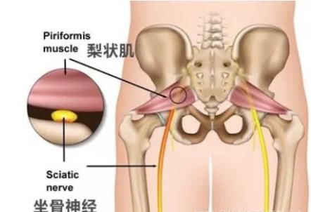 臀部|梨状肌综合征：导致臀部疼痛的罪魁祸首！