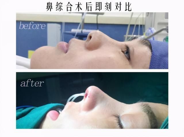 隆鼻|知名女星惊现“女巫鼻”天价隆鼻就能整出好鼻子