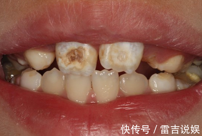 刷牙|让孩子“烂牙”的不是糖,是家长无知!3种错误行为,一定要避免