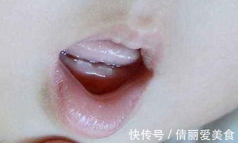 莎莎|1岁儿子总撅“金鱼嘴”,妈妈还在夸可爱,奶奶掰开嘴后直奔医院